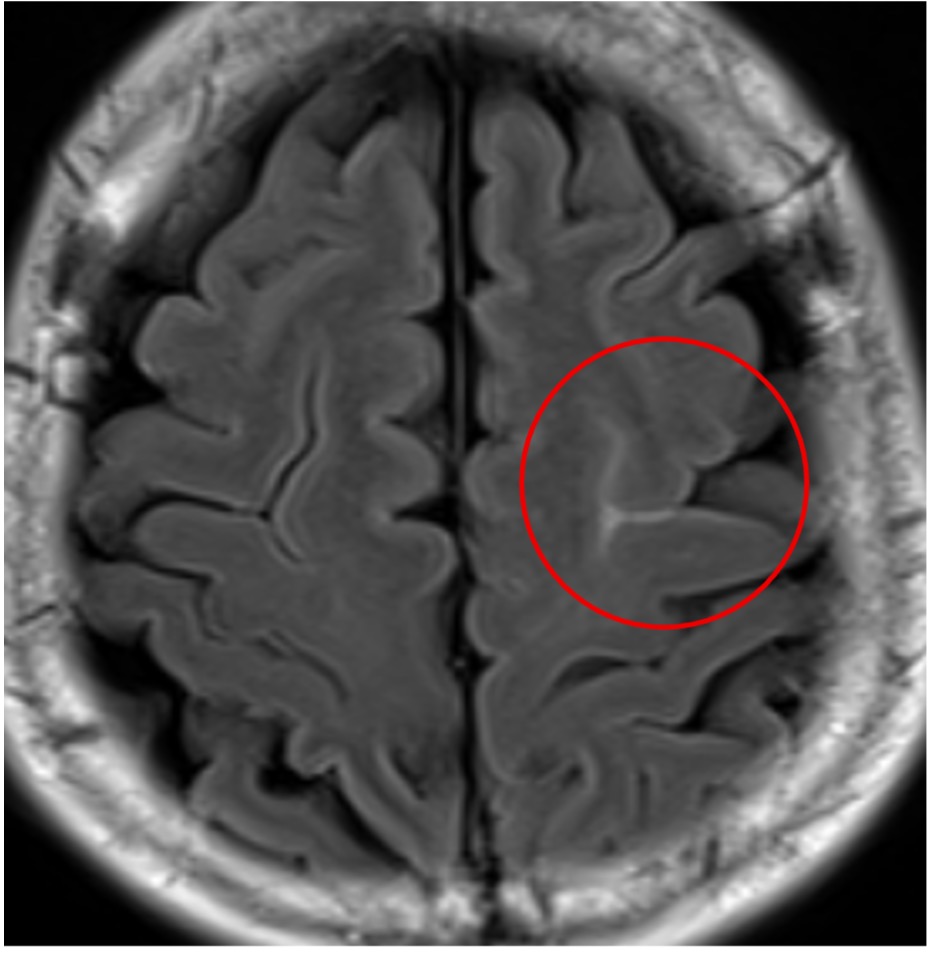 円蓋部（えんがいぶ）くも膜下出血