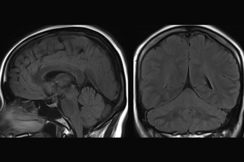 低頭蓋内圧性頭痛・脳脊髄液漏出症