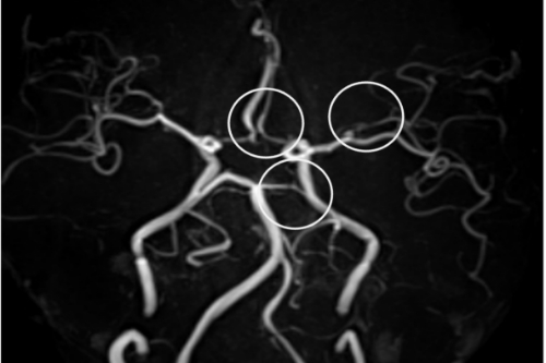 可逆性脳血管攣縮症候群（RCVS）による頭痛